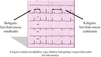 EKG-görbe, légzési aritmia hatása a szívfrekvenciára, belégzéskor emelkedés, kilégzéskor csökkenés