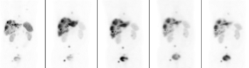 Öt különböző PET/CT felvétel, amelyek a test különböző részein mutatnak aktivitást.